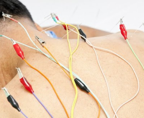 Châm cứu điều trị đau vai gáy