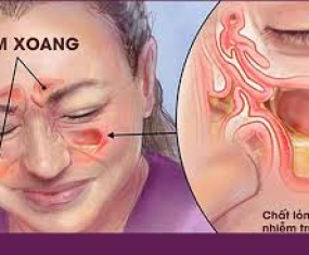 CHÂM CỨU ĐIỀU TRỊ VIÊM XOANG