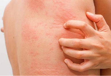 Ngứa da điều trị ở hiệp bình,TP.Hồ Chí Minh